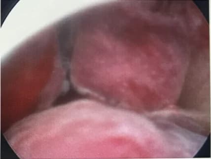 子宮鏡下子宮內膜息肉實際影像(一)